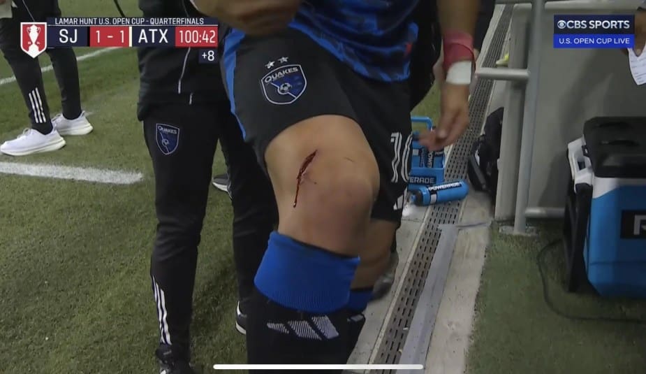 7/9/25 Cristian Espinoza suffered a severe cut above his right knee during a match, requiring 10 stitches. He was injured by a high kick, but the opposing player only received a yellow card. His availability for the upcoming game is uncertain.